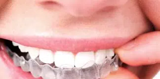 invisalign