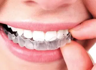 invisalign